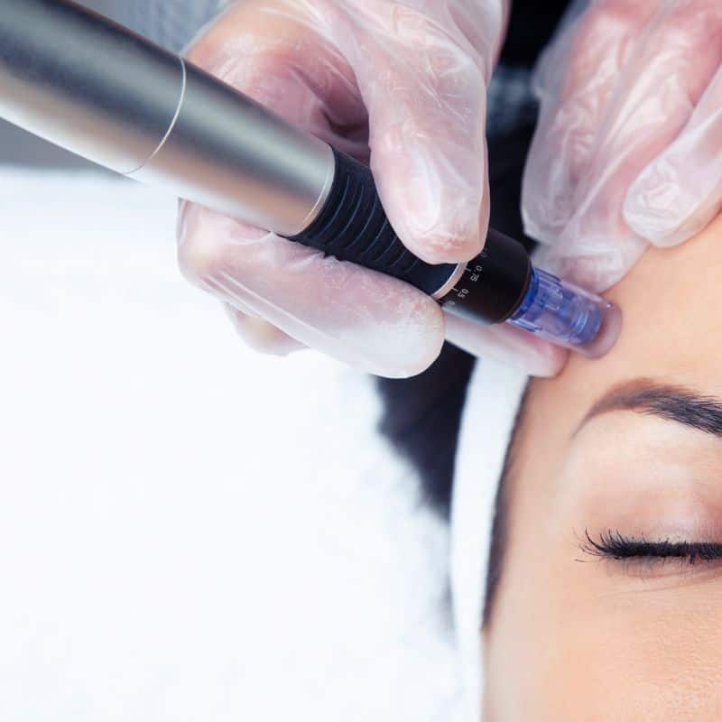 Morpheus8 treatment Salford Quays from Lipo Sculpt - Book in today!